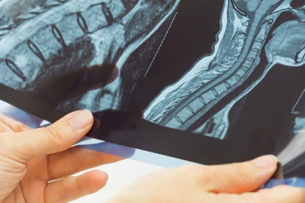 Spinal-Injury-19.3.25-595xh Spinal-Injury-19.3.25-595xh