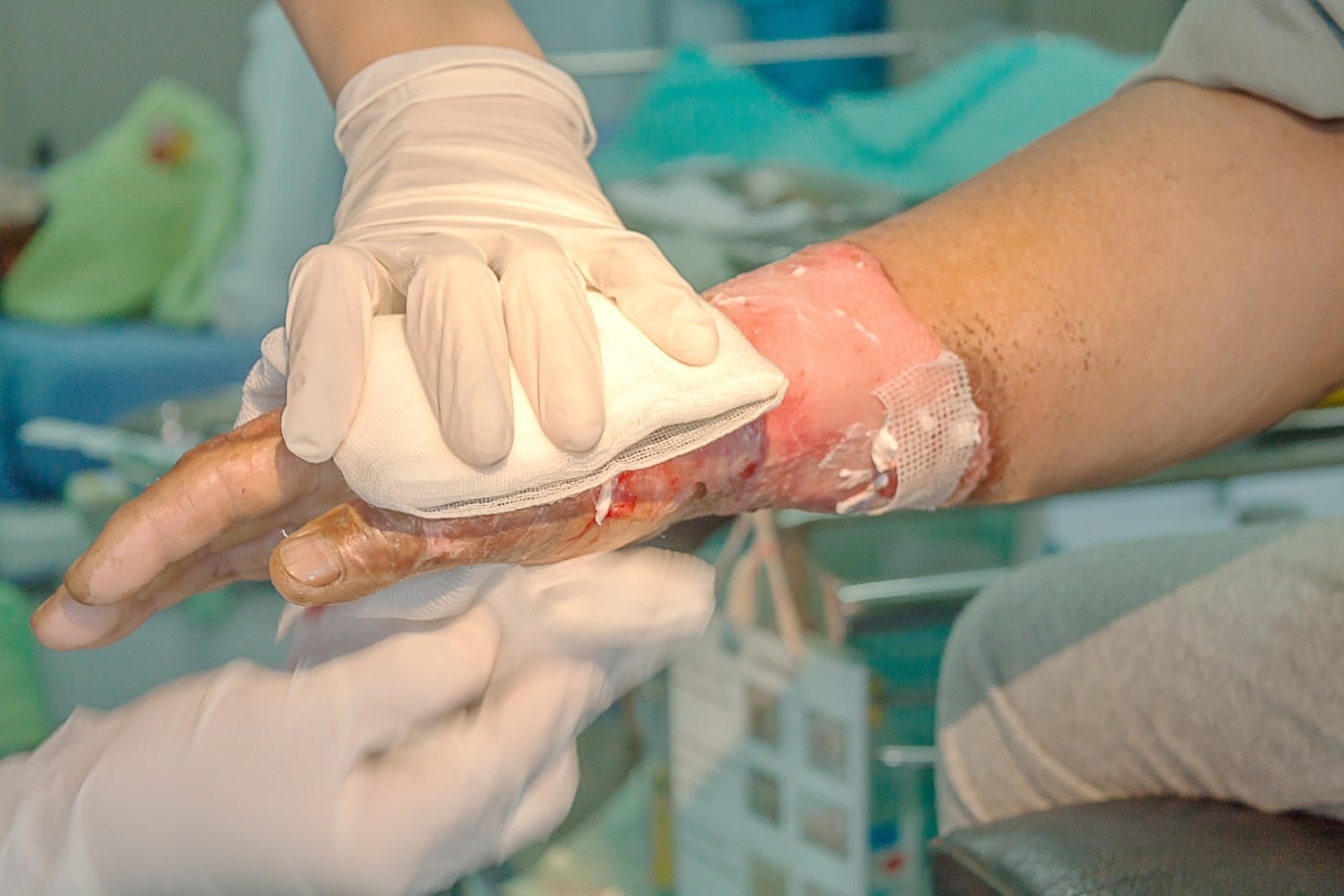 Why Do Burn Injuries Happen at Fort Worth Worksites? Why Do Burn Injuries Happen at Fort Worth Worksites?