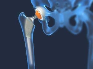 Helping Hip/Knee/Ankle Replacement Patients with Defective Implants